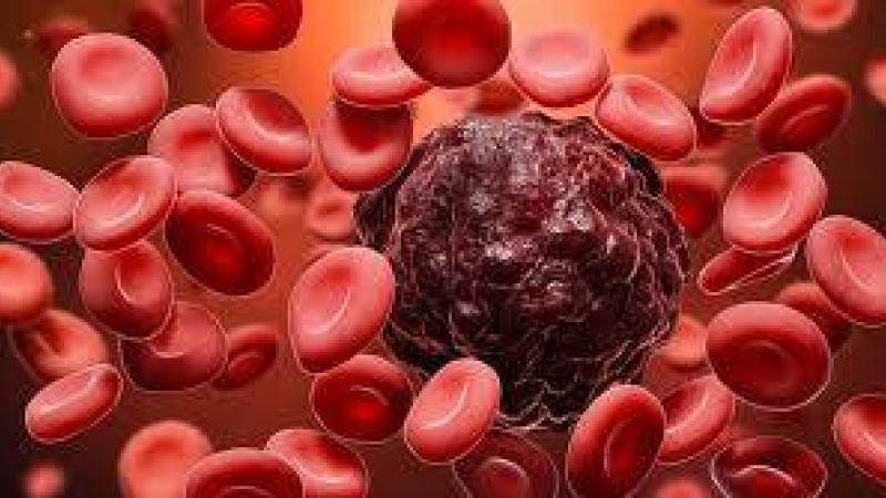 سرطان الدم ينشأ أثناء نمو الجنين