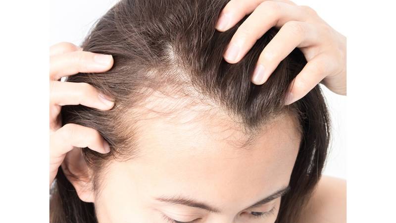 تساقط الشعر مشكلات صحية ووراثية صحيفة الخليج