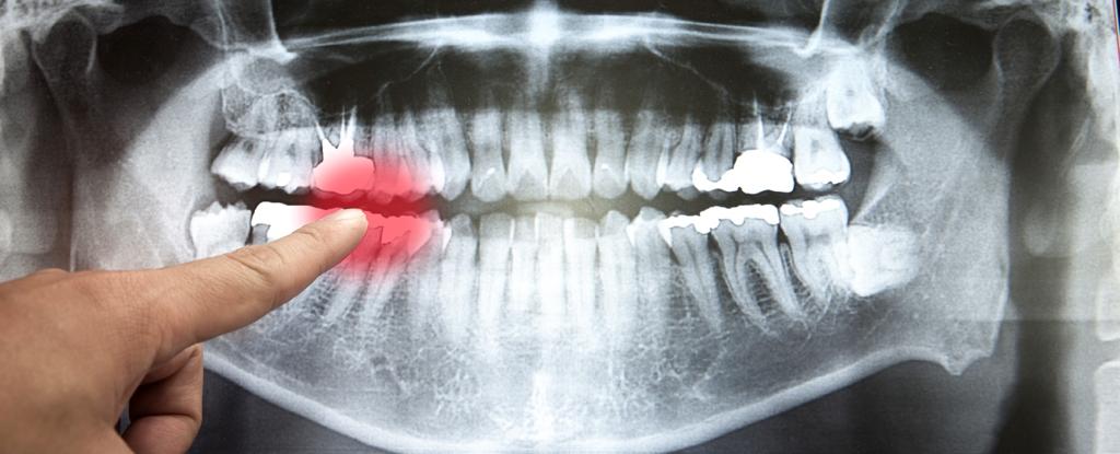 Tooth loss is linked to heart disease