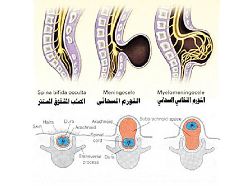 Spina bifida. Spina Bifida Occulta у новорожденных. Spina Bifida Occulta s1 позвонка..